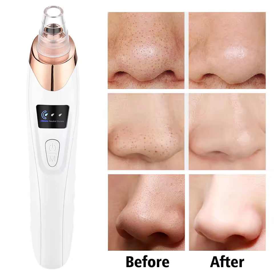 Blackhead Pore Removing Vacuum