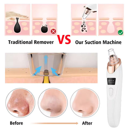 Blackhead Pore Removing Vacuum